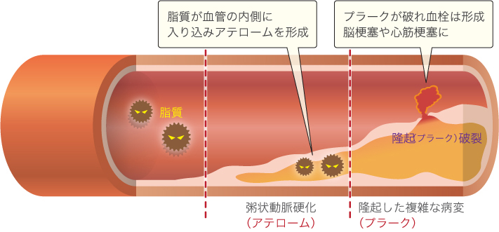 動脈硬化