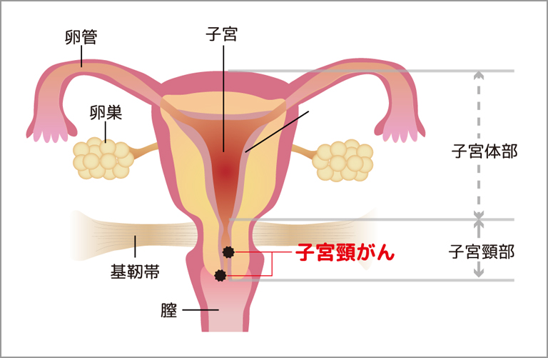 子宮頸がんイラスト