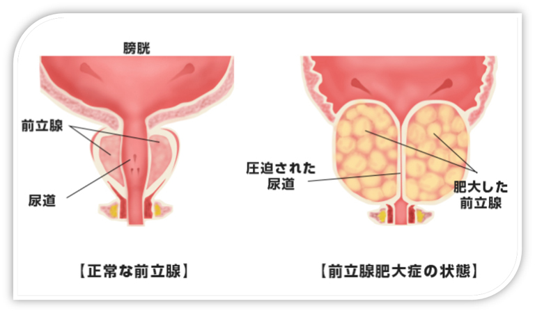 前立腺イラスト